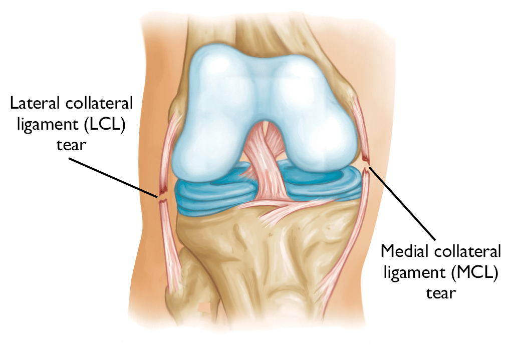MCL LCL Image